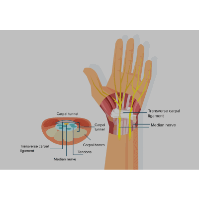 Carpal Tunnel Syndrome - Orthoanswer