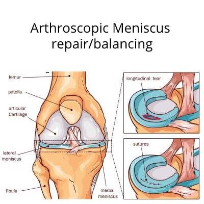 minscus-surgery